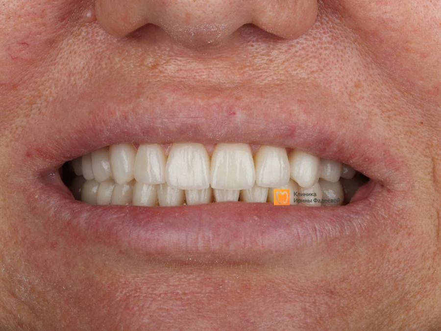Кейсы Тотальная реабилитация — после