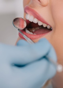 Эстетическая реставрация зубов