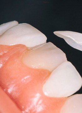 Керамические коронки