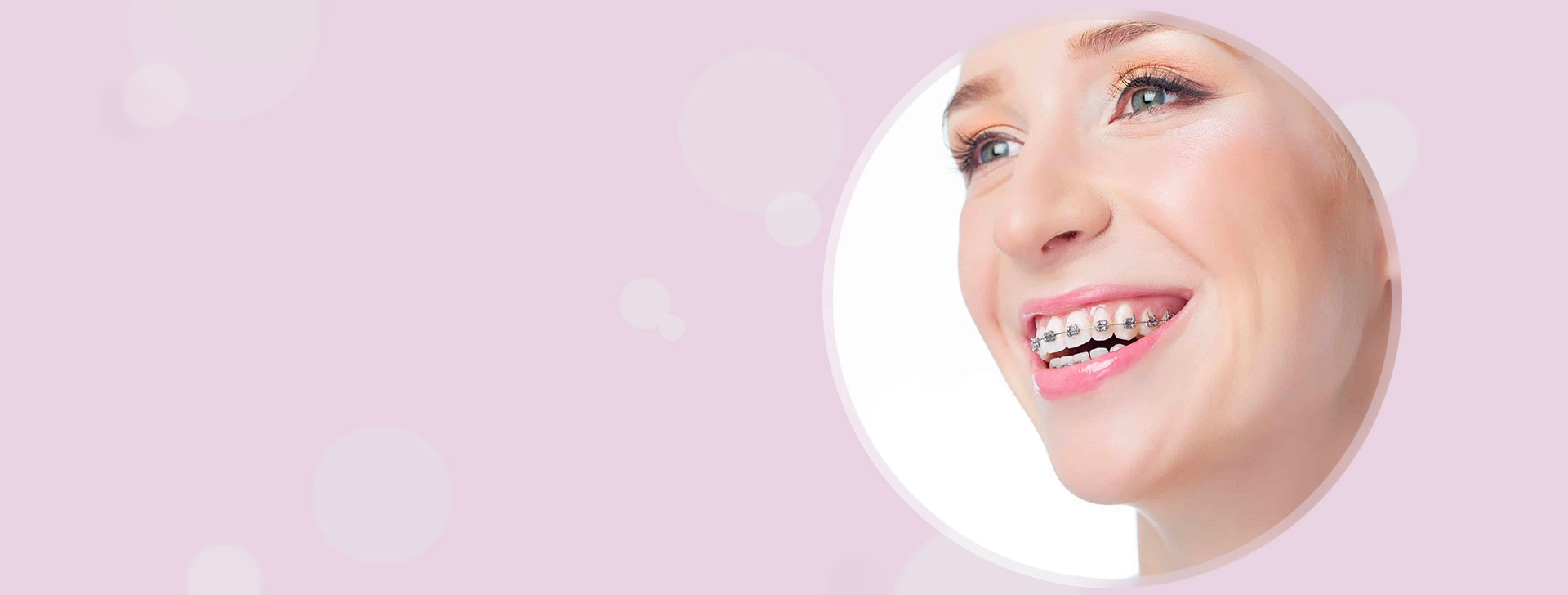 Брекеты Damon