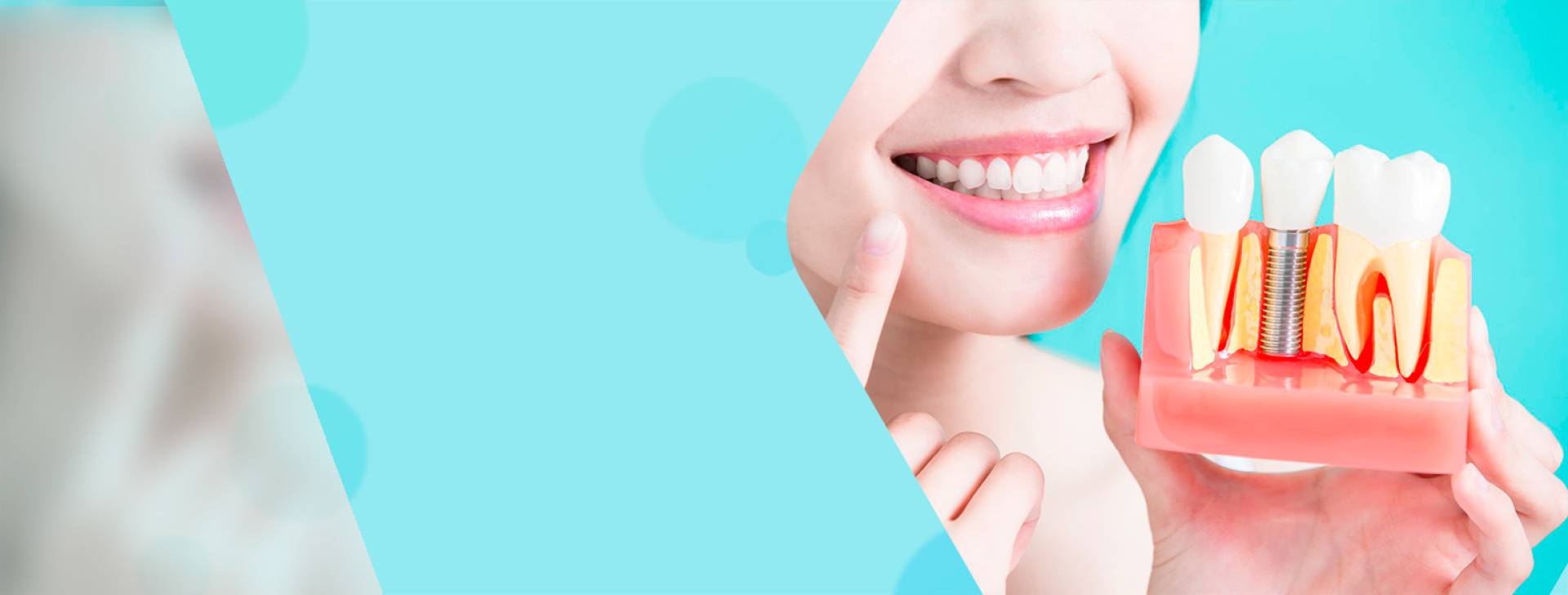 Классическая имплантация зубов